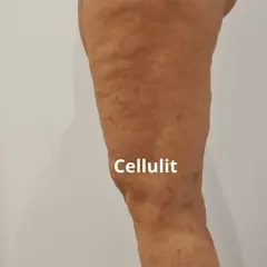 Co wam pomogło na cellulit? Skuteczne metody, które działają