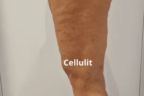 Co wam pomogło na cellulit? Skuteczne metody, które działają