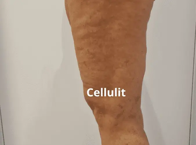Co wam pomogło na cellulit? Skuteczne metody, które działają